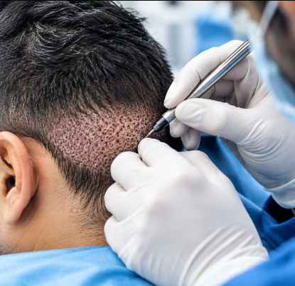 Hair Follicle Extraction by DHI